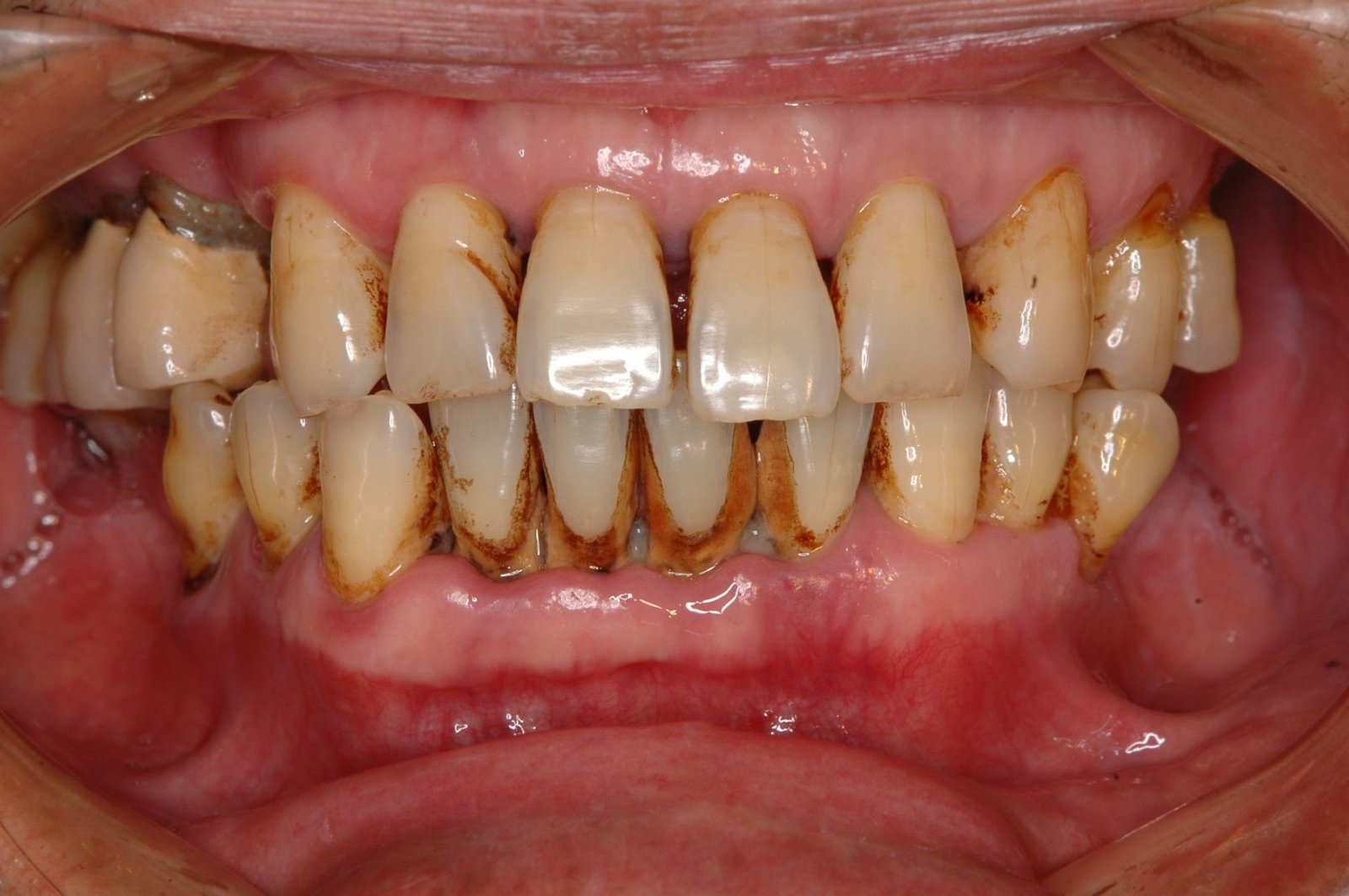 Tratamiento periodontal